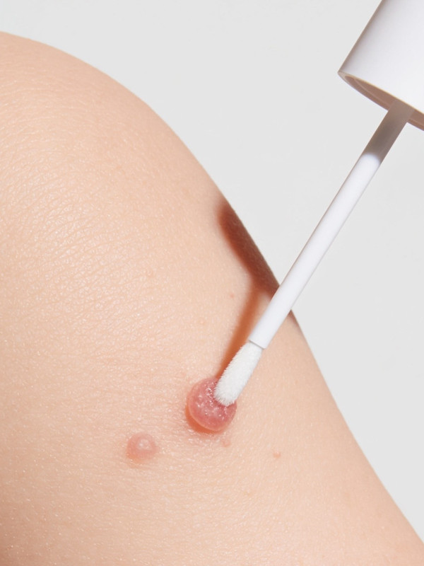 Molusderm est indiqué dans le traitement du Molluscum contagiosum